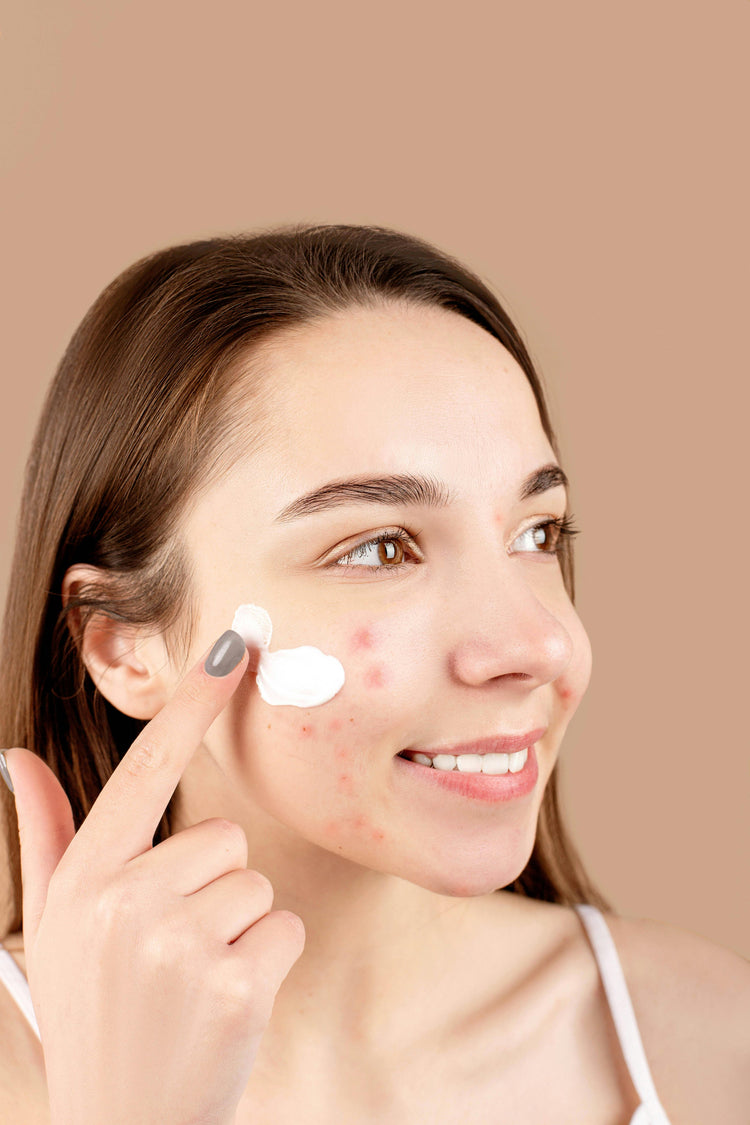 ACNE Y PIEL GRASA